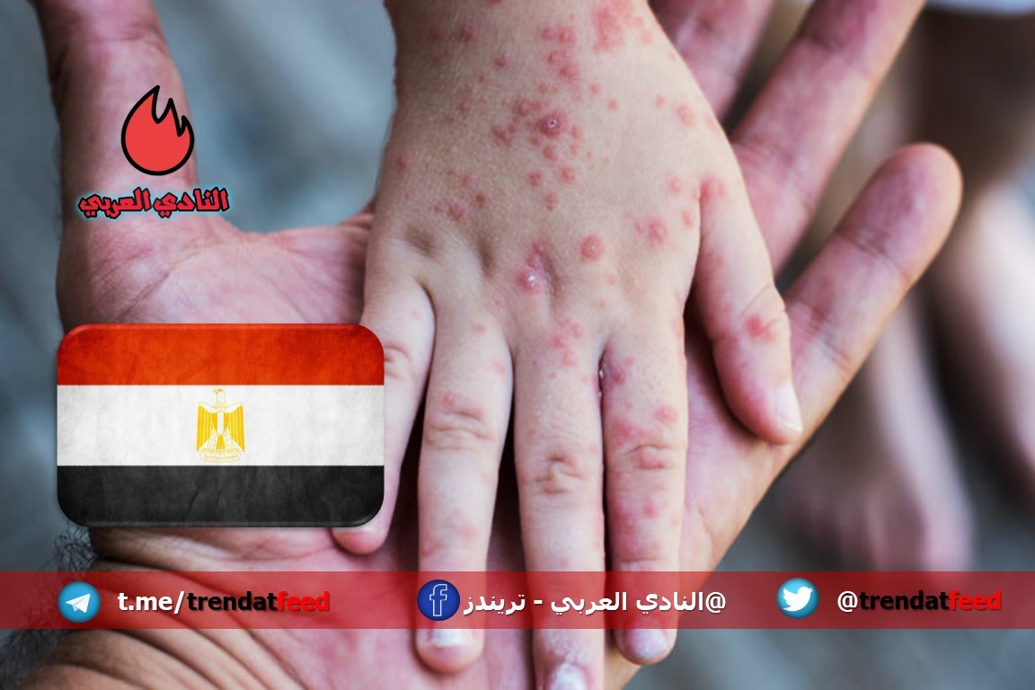 وزارة التربية تتخذ قرارات عاجلة لمكافحة وباء الجدري المائي في مصر 3 وزارة التربية تتخذ قرارات عاجلة لمكافحة وباء الجدري المائي في مصر